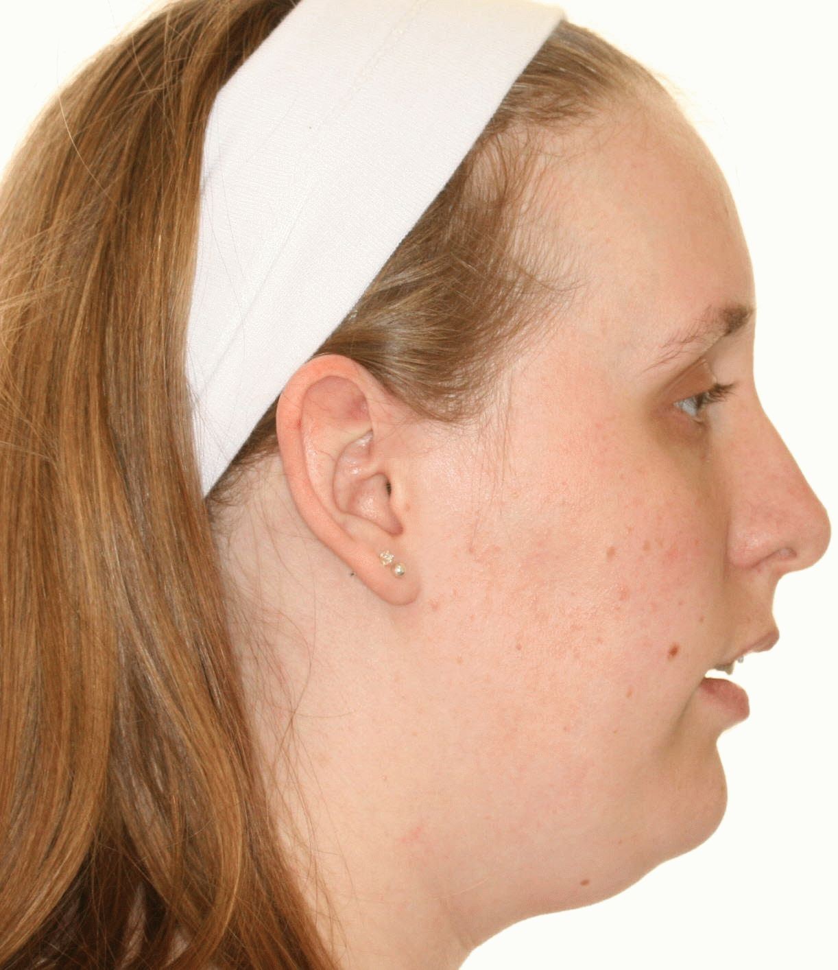 What are some tips for comparing neck surgeons?
